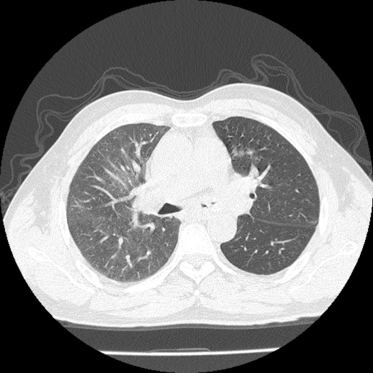 Airway foreign body in adult (Radiopaedia 85907-101779 Axial lung window 65).jpg