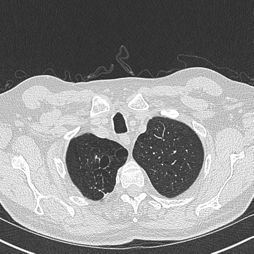 Allergic bronchopulmonary aspergillosis (Radiopaedia 44760-48571 Axial lung window 9).png