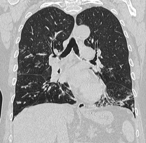 Alpha-1-antitrypsin deficiency (Radiopaedia 72058-82557 Coronal lung window 44).jpg