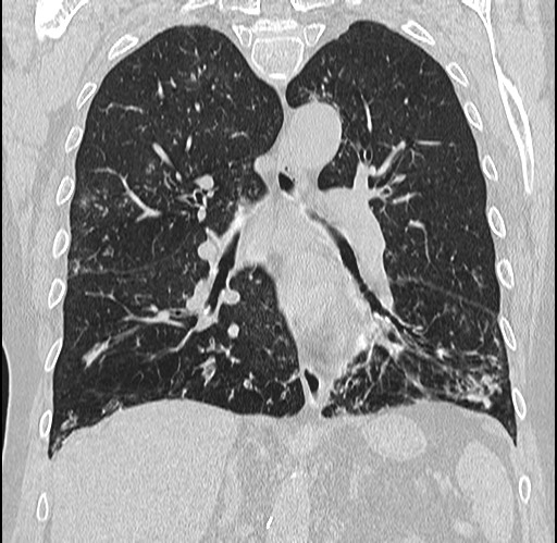 Alpha-1-antitrypsin deficiency (Radiopaedia 72058-82557 Coronal lung window 50).jpg