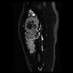 Alveolar soft part sarcoma (Radiopaedia 64501-73678 D 77).jpg