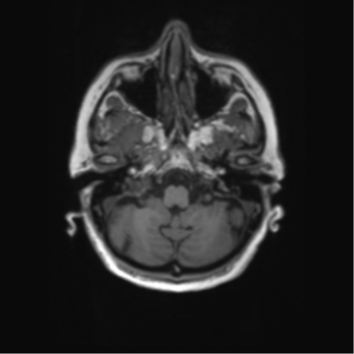File:Alzheimer's disease (Radiopaedia 42658-45802 Axial T1 125).png