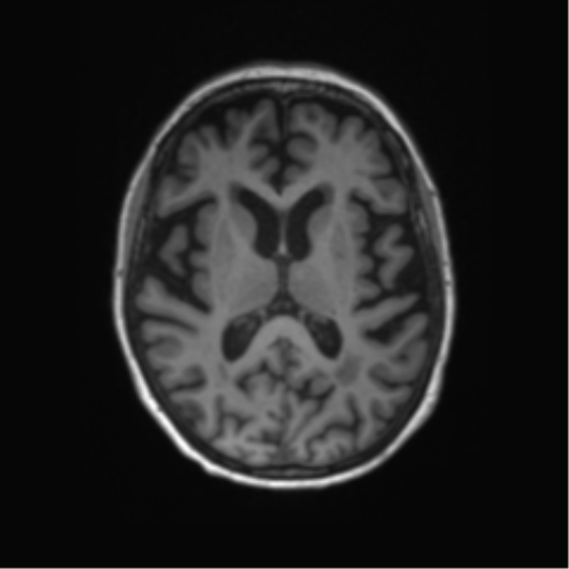 Alzheimer's disease (Radiopaedia 42658-45802 Axial T1 74).png
