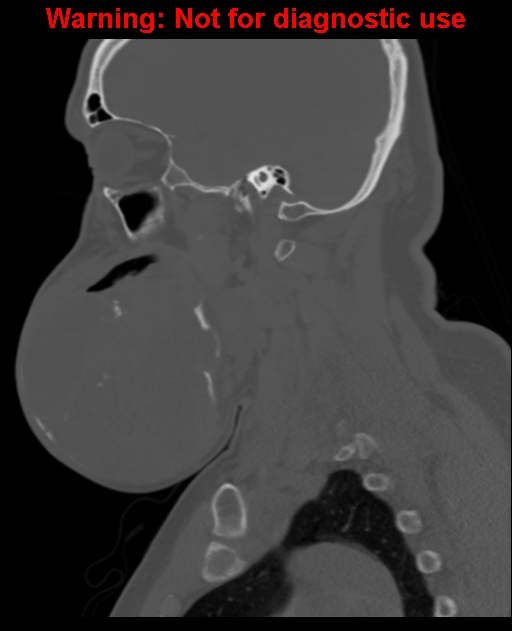 Ameloblastoma (Radiopaedia 33126-34164 Sagittal bone window 29).jpg