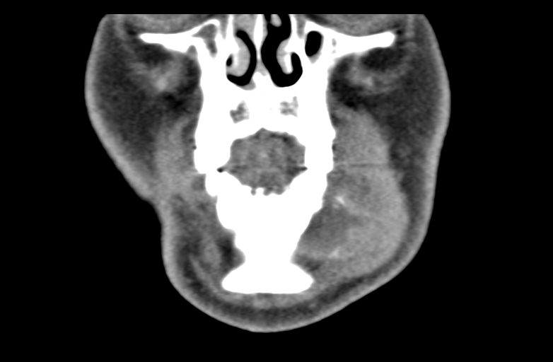 Ameloblastoma (Radiopaedia 33677-34806 Coronal non-contrast 16).png