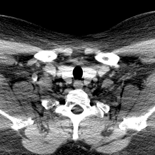 Ameloblastoma (Radiopaedia 38520-40623 Axial non-contrast 69).png
