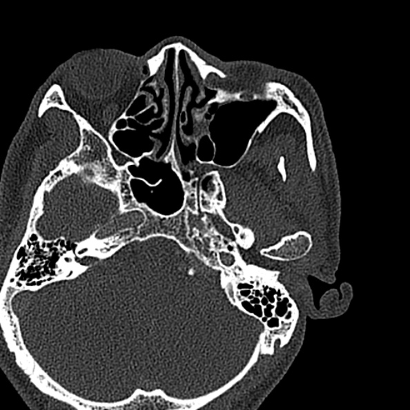 Ameloblastoma (Radiopaedia 51921-57766 Axial bone window 153).jpg