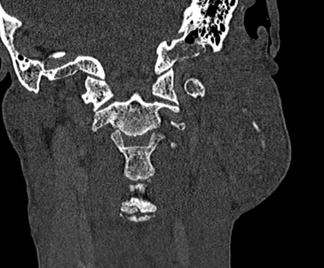 Ameloblastoma (Radiopaedia 51921-57766 Coronal bone window 230).jpg