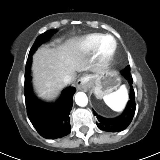 Ampullary adenocarcinoma (Radiopaedia 34013-35237 B 9).png