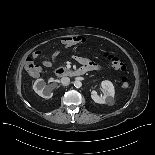 Ampullary adenocarcinoma (Radiopaedia 59373-66737 A 70).jpg