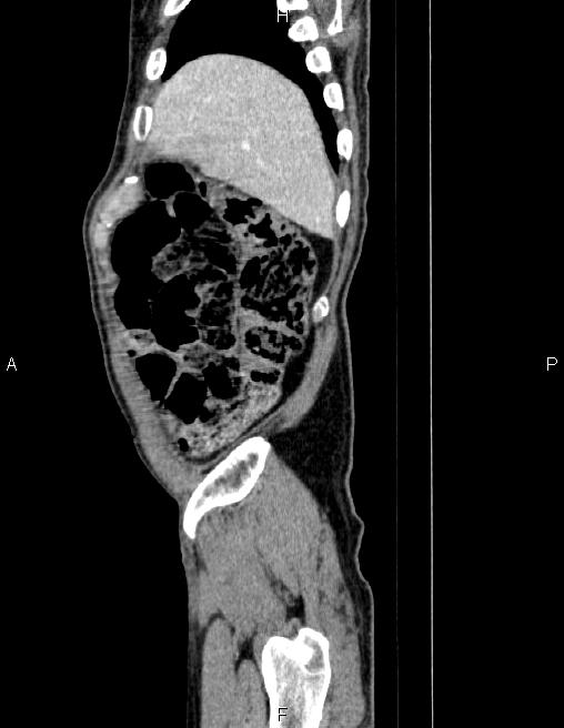 Ampullary adenocarcinoma (Radiopaedia 86093-102032 D 9).jpg