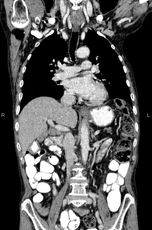 Ampullary adenocarcinoma (Radiopaedia 86093-102033 D 29).jpg