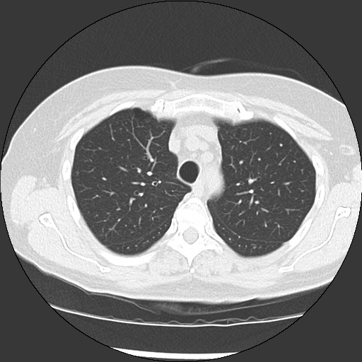 Amyloidosis - bronchial and diffuse nodular pulmonary involvement (Radiopaedia 60156-67744 B 16).jpg