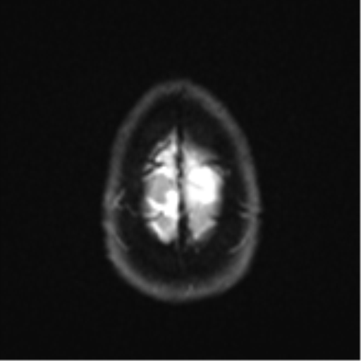 Anaplastic astrocytoma (Radiopaedia 57768-64731 Axial DWI 27).png