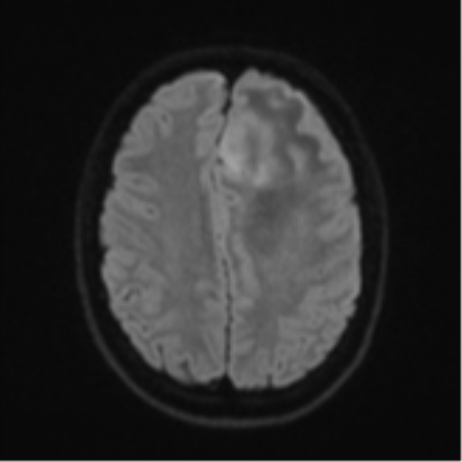 Anaplastic astrocytoma (Radiopaedia 57768-64731 Axial DWI 48).png