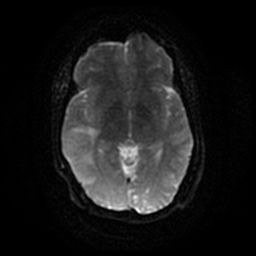 File:Anaplastic astrocytoma (WHO grade III) (Radiopaedia 23559-23664 Axial DWI 31).jpg