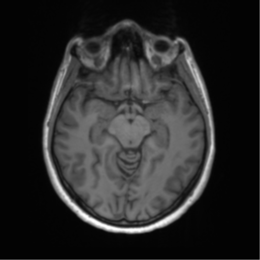 File:Anaplastic astrocytoma - thalamic glioma (Radiopaedia 59709-67115 Axial T1 8).png