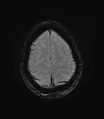 File:Anaplastic astrocytoma IDH mutant (Radiopaedia 50046-55341 Axial SWI 76).png