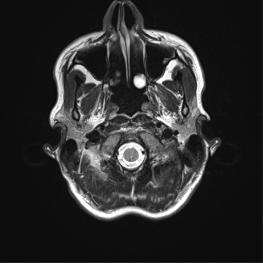 File:Anaplastic astrocytoma IDH mutant (Radiopaedia 50046-55341 Axial T2 4).png