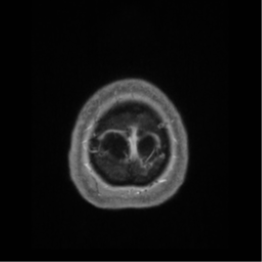 Anaplastic astrocytoma IDH wild-type (pseudoprogression) (Radiopaedia 42209-45276 Axial T1 C+ 142).png