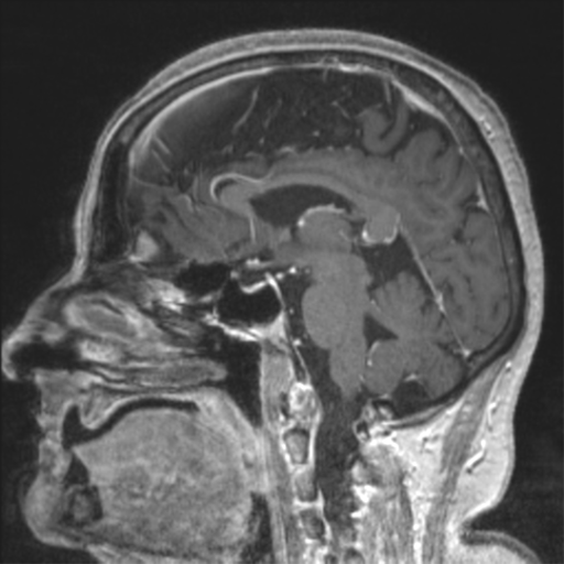 File:Anaplastic astrocytoma IDH wild-type (pseudoprogression) (Radiopaedia 42209-45277 Axial T1 C+ 133).png