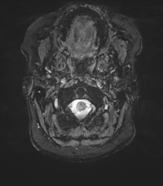 Anaplastic oligodendroglioma (Radiopaedia 83500-98599 L 1).png