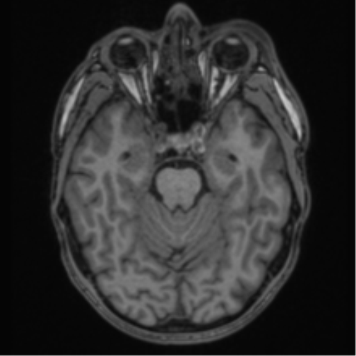 Anaplastic oligodendroglioma with skull fracture (Radiopaedia 74831-85845 Axial T1 20).png