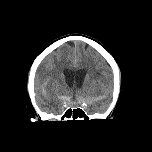 Aneursym related subarachnoid hemorrhage with hydrocephalus (Radiopaedia 45105-49083 Coronal non-contrast 27).jpg