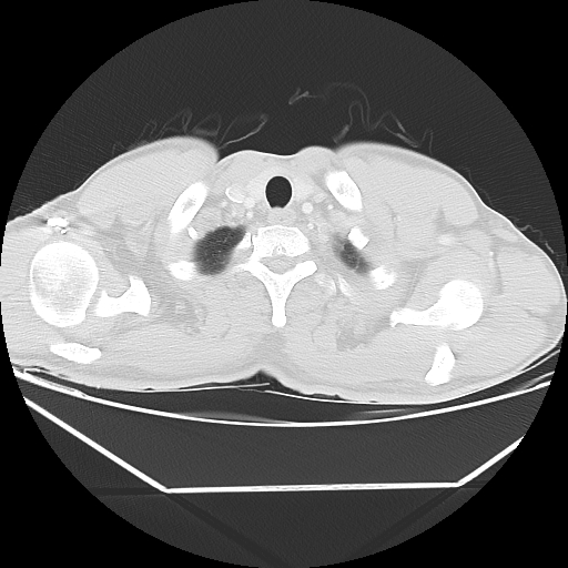 Aneurysmal bone cyst - rib (Radiopaedia 82167-96220 Axial lung window 11).jpg