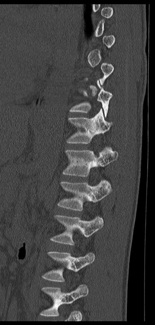 Aneurysmal bone cyst T11 (Radiopaedia 29294-29721 Sagittal bone window 27).jpg