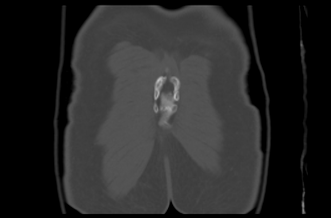 File:Aneurysmal bone cyst of ischium (Radiopaedia 25957-26094 Coronal bone window 46).png