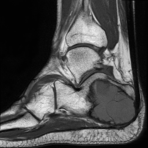 File:Aneurysmal bone cyst of the calcaneus (Radiopaedia 60669-68420 Sagittal T1 7).jpg