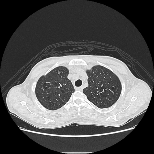 Angioinvasive aspergellosis (Radiopaedia 66995-76315 Axial lung window 8).jpg
