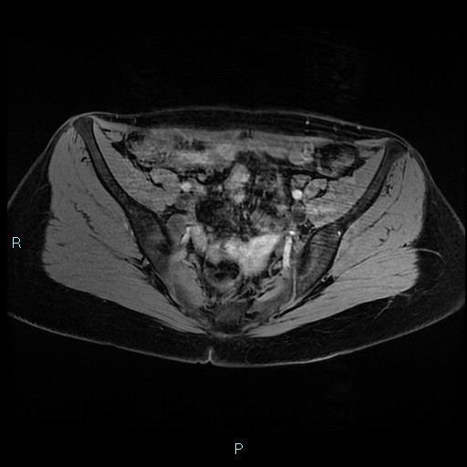 Angioleiomyoma (Radiopaedia 85442-101078 Axial T1 3D fat sat 6).jpg