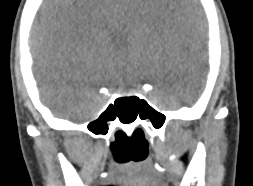 Angular dermoid cyst (Radiopaedia 88967-105790 Coronal non-contrast 53).jpg