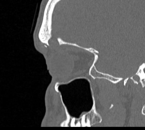 Angular epidermoid cyst (Radiopaedia 46908-51439 Sagittal bone window 70).png