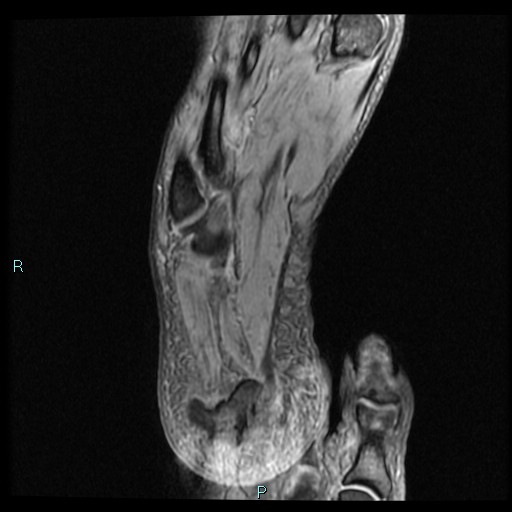 Ankle ganglion cyst (Radiopaedia 62809-71162 Axial Gradient Echo 2).jpg