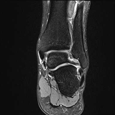 Ankle syndesmotic injury (Radiopaedia 69066-78837 Coronal PD fat sat 25).jpg