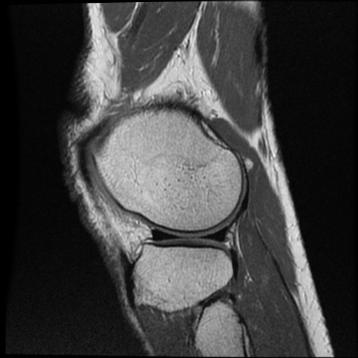 File:Anomalous insertion of the medial meniscus (Radiopaedia 77559-89721 Sagittal PD 14).jpg