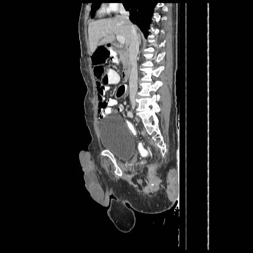 Anorectal carcinoma (Radiopaedia 44413-48064 C 44).jpg