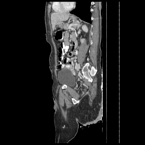 Anorectal carcinoma (Radiopaedia 44413-48064 C 68).jpg