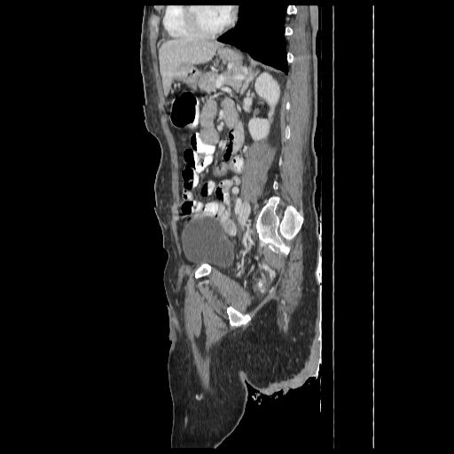 Anorectal carcinoma (Radiopaedia 44413-48064 C 69).jpg