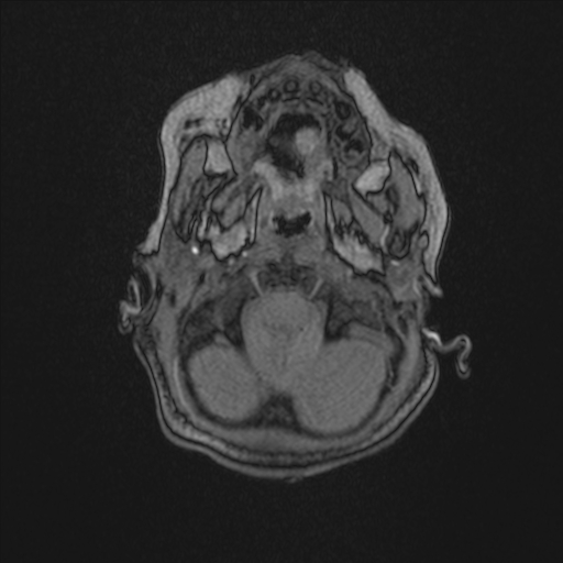 Anoxic brain injury (Radiopaedia 79165-92139 Axial MRA 24).jpg