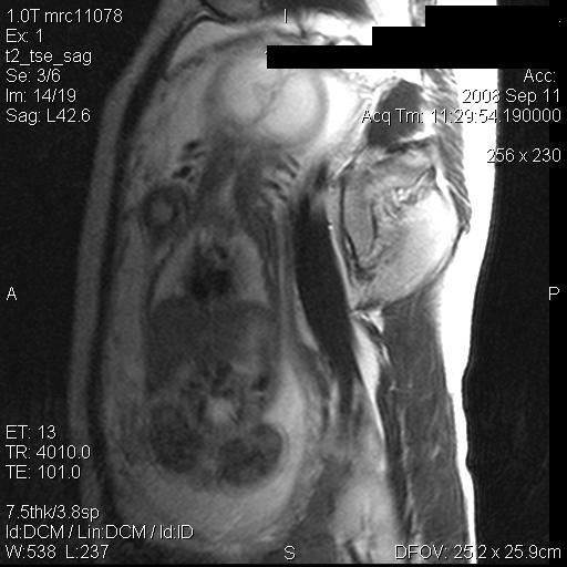 File:Antenatal MRI with meningocoele (Radiopaedia 5286-7036 D 1).jpg