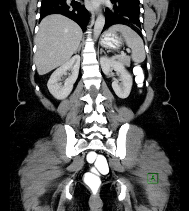 Anterior abdominal wall CSF pseudocyst (CSFoma) (Radiopaedia 79453-92571 B 39).jpg