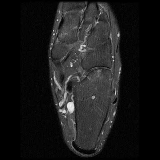 File:Anterior calcaneal process fracture (Radiopaedia 74654-85611 Axial PD fat sat 18).jpg