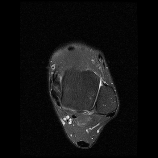 File:Anterior calcaneal process fracture (Radiopaedia 74654-85611 Axial PD fat sat 7).jpg