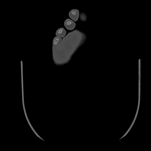 Anterior calcaneal process fracture (Radiopaedia 82590-96762 Axial bone window 49).jpg