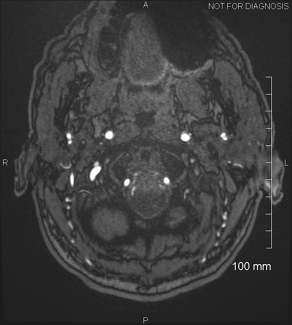 Anterior cerebral artery aneurysm (Radiopaedia 80683-94127 Axial MRA 2).jpg