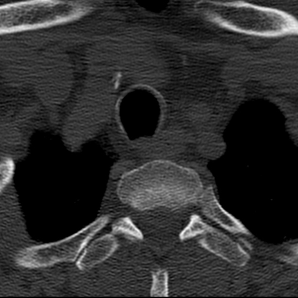 Anterior cervical postdiscectomy arthrodesis (Radiopaedia 32678-33646 Axial bone window 73).jpg
